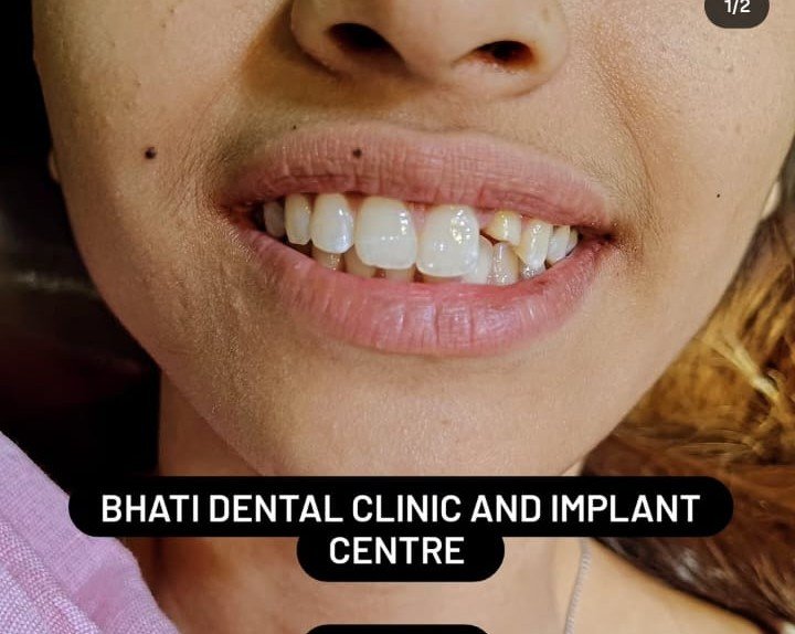 Before smile design treatment at Bhati Dental Clinic